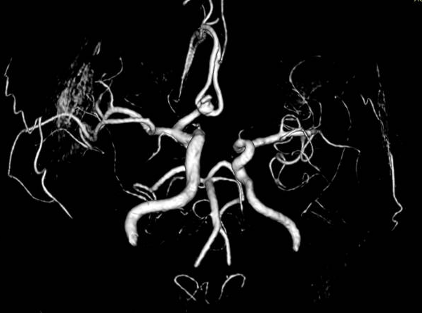 After the Blockage Report: How Doctors Decide Between Medicine, Angioplasty, and Surgery