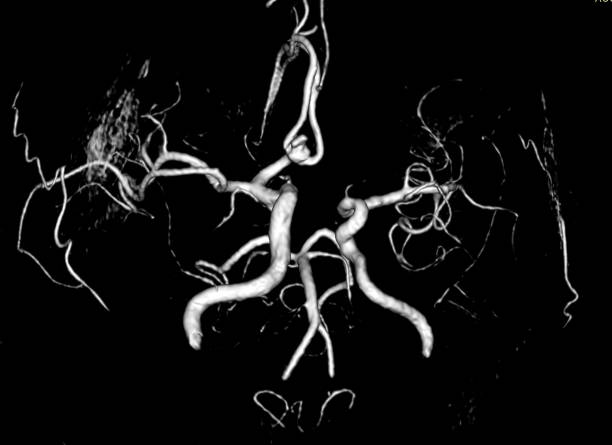After the Blockage Report: How Doctors Decide Between Medicine, Angioplasty, and Surgery